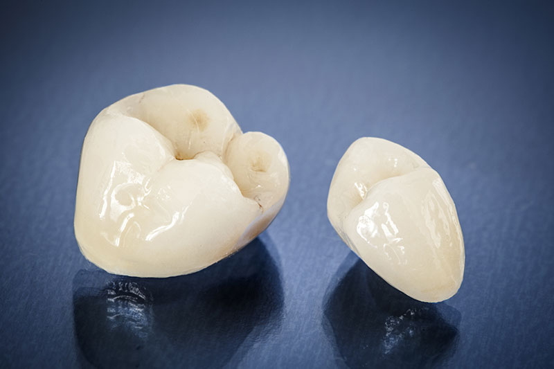 Porcelain Crowns in Davis