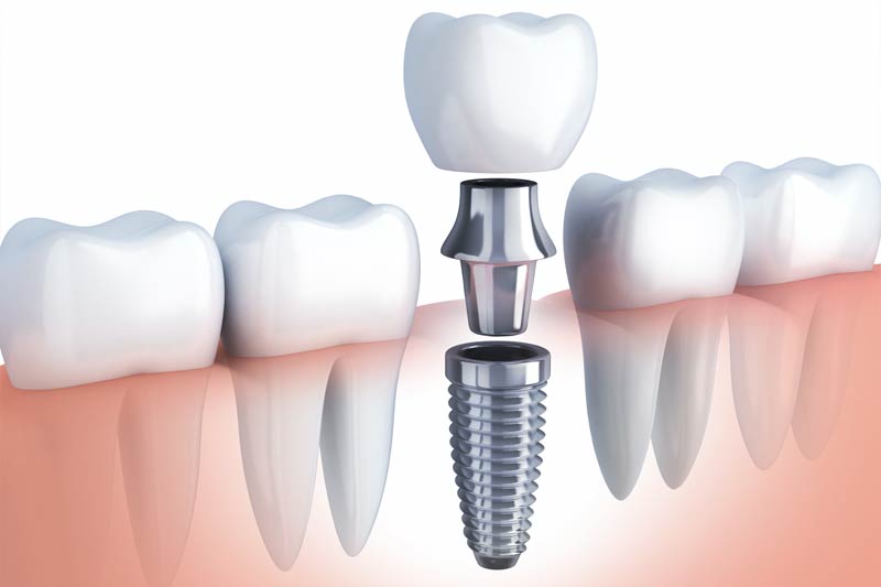 Dental Implants and Dental Crowns in 