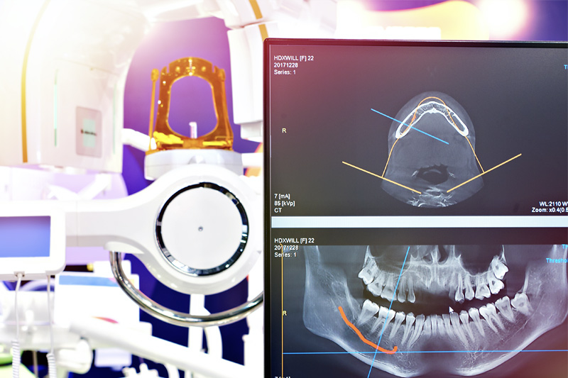 Digital X-Rays in Davis